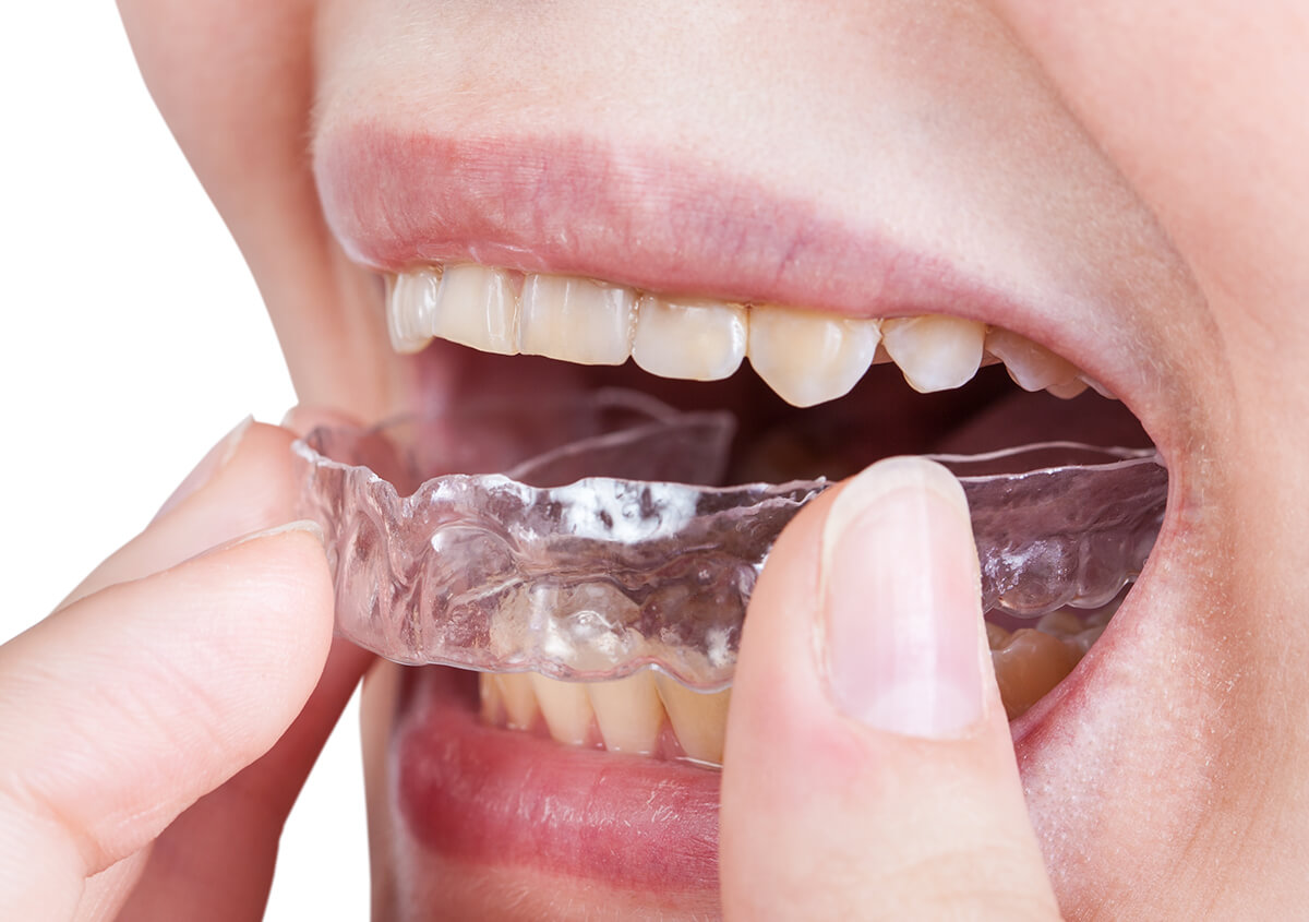 Invisalign Teeth Treatment in Bermuda Area