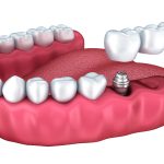 What Is The Real Cost Of Dental Implants Services Near Me In Devonshire, Bermuda