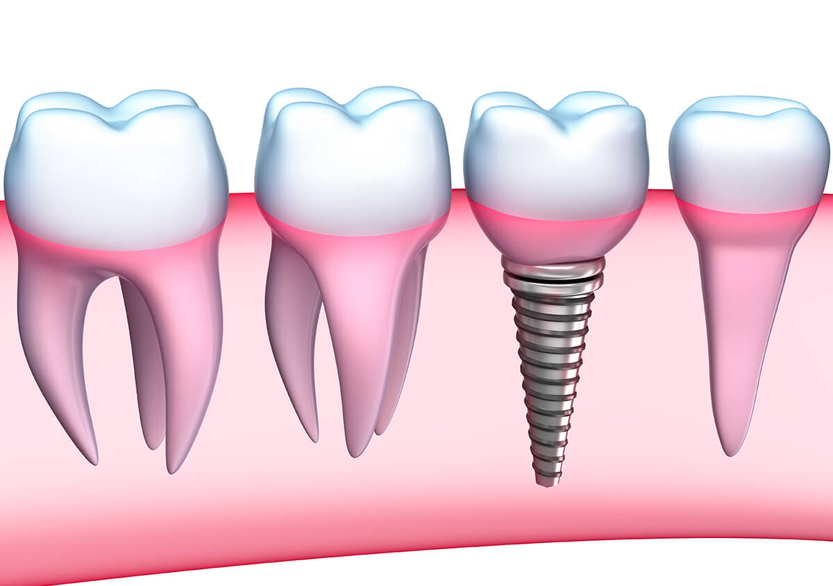 Dental Implant Surgery in Devonshire BM Area