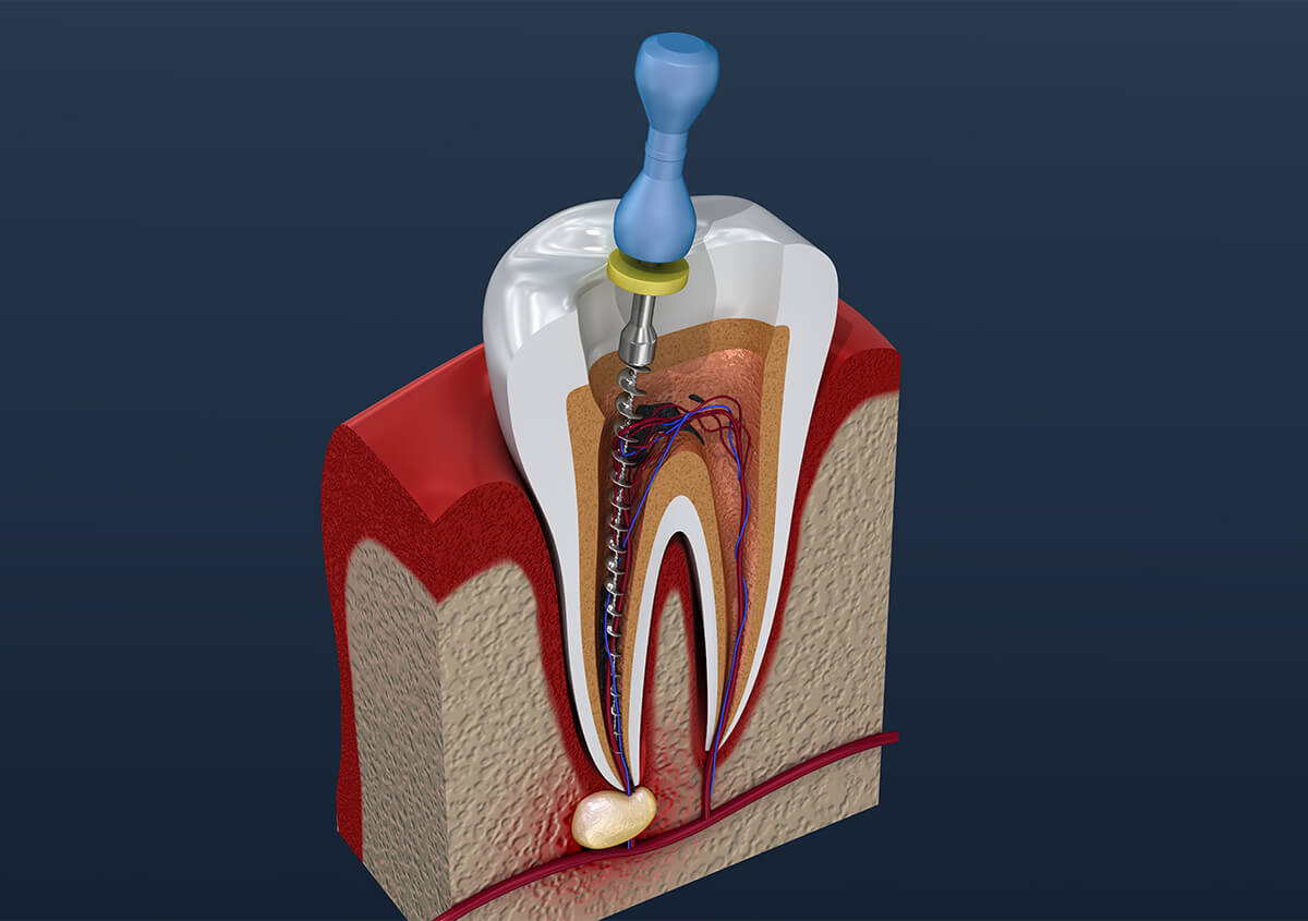 Why Do You Need a Root Canal in Devonshire BM Area